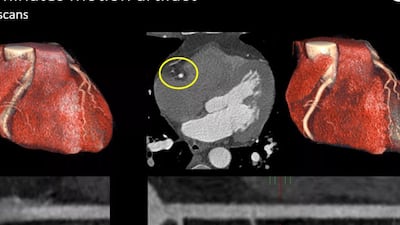 Focus On Cardio-Oncology, Clinical Trends And AI At ESC 2024